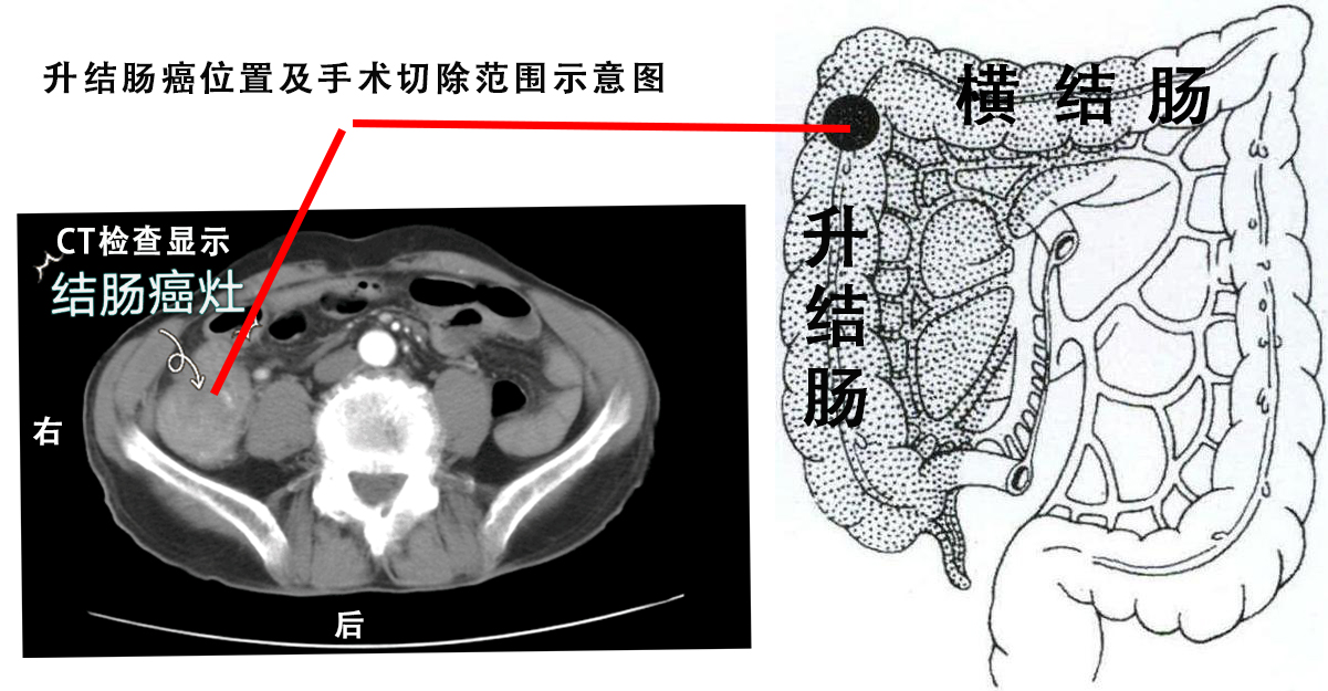 升结肠癌位置及手术切除范围示意图.jpg