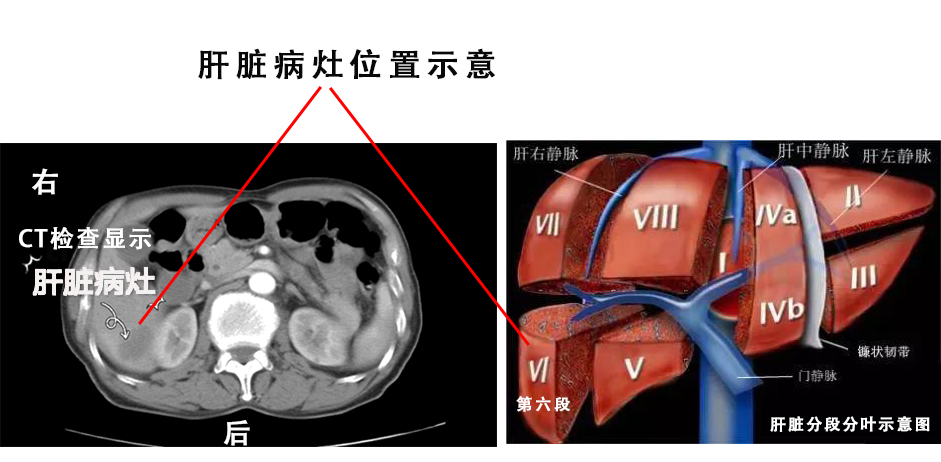 肝脏分段分叶示意图.jpg