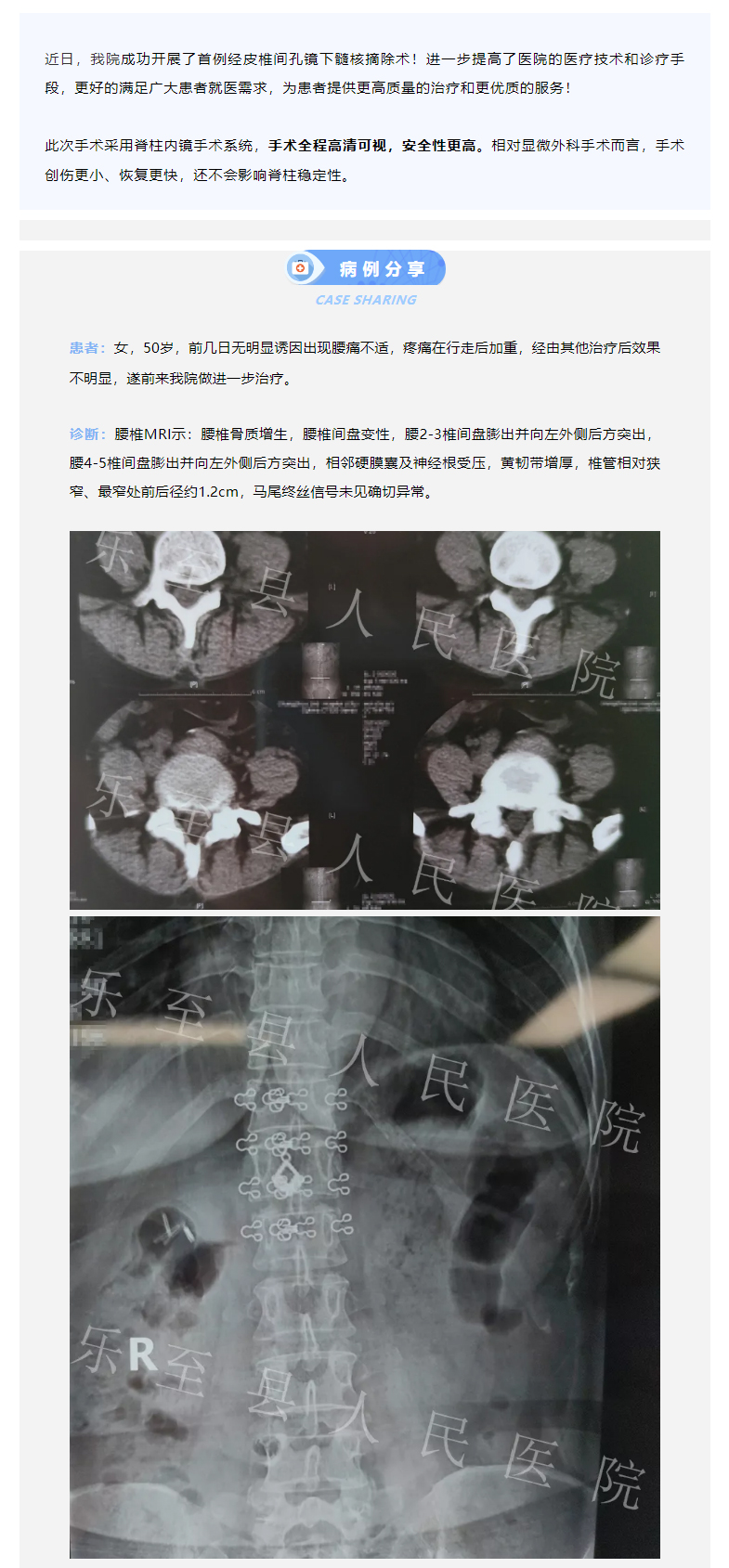 【新突破】乐至县人民医院成功开展首例经皮椎间孔镜下髓核摘除术！_03.jpg