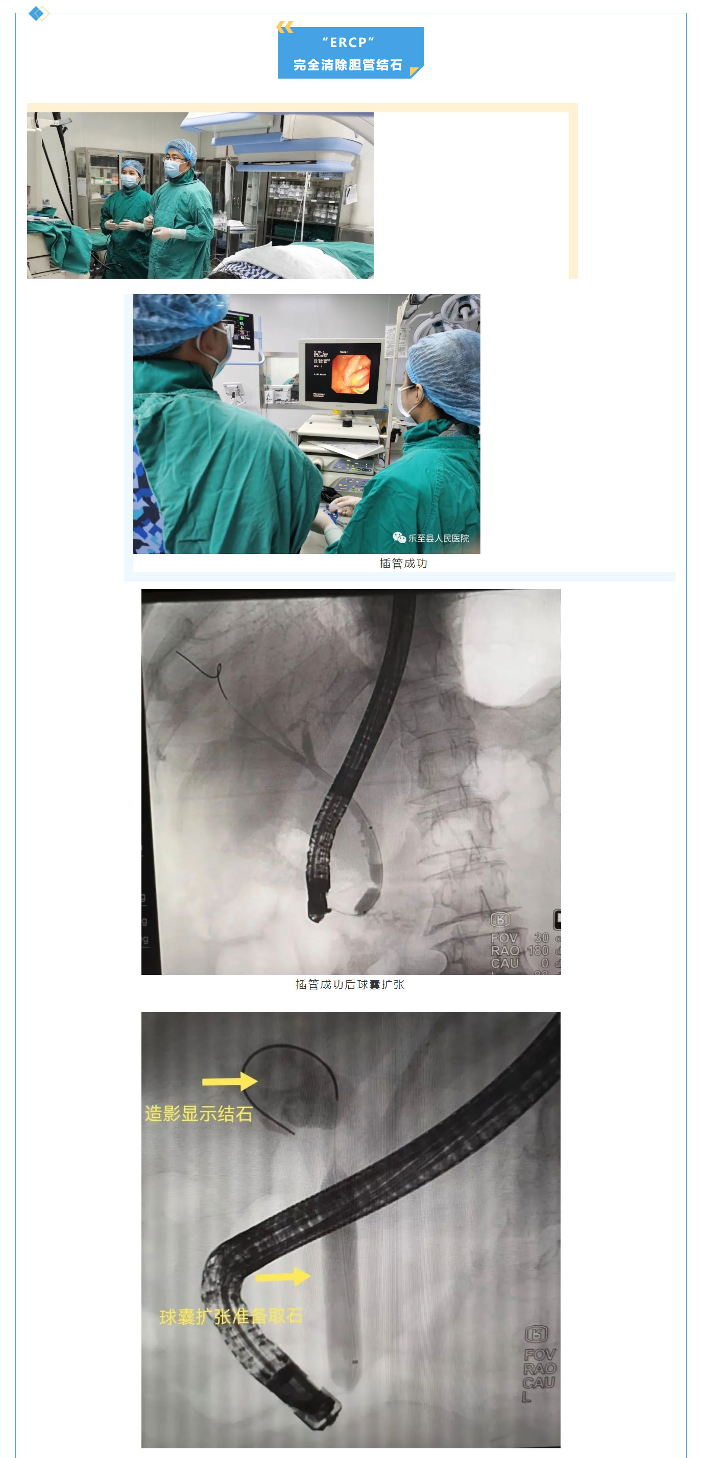 【新突破】微创技术“ERCP_，不开刀就能取胆管结石！_03.jpg